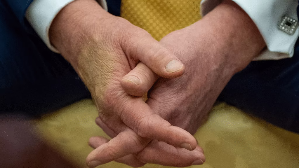 Donald Trump Diagnosed With Chronic Venous Insufficiency 4 image 13